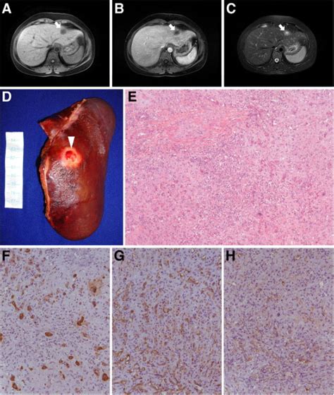 Hepatic Epithelioid Hemangioendothelioma An Unusual Lesion Of The