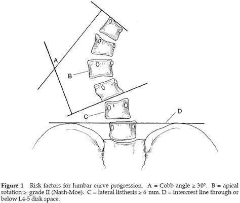 Degenerative Lumbar Scoliosis