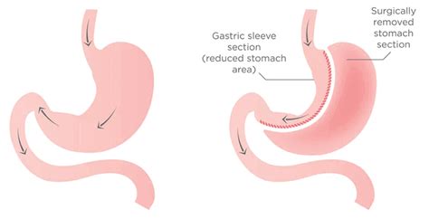 Post Op Diet Certified Bariatric Surgeons