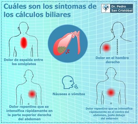 Cuales son los síntomas de los cálculos biliares Cirugia de