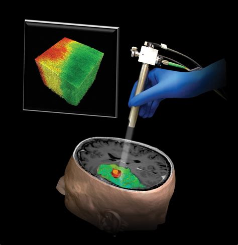 Better Brain Surgery - JHU Engineering Magazine