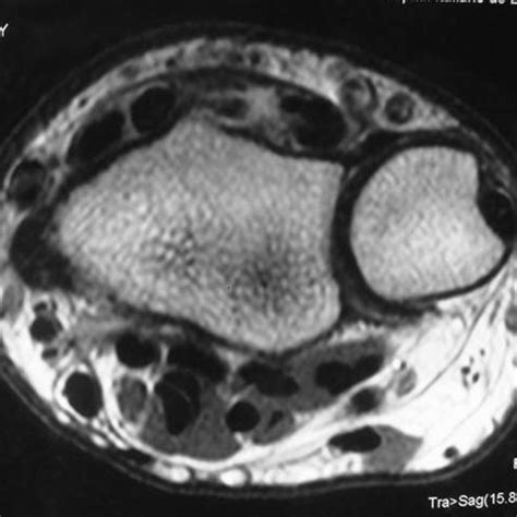 Pdf Bilateral Rupture Of The Extensor Pollicis Longus Tendon A Case