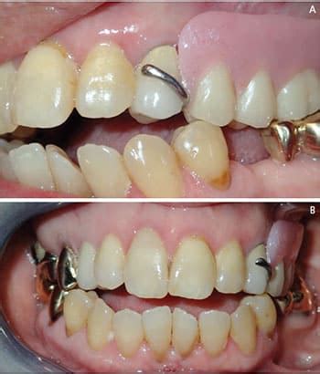 denture-fig-7 - Decisions in Dentistry