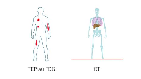 L étude TEP au FDG en médecine nucléaire YouTube