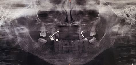 Radiograf A Panor Mica Dental Imagen Radiol Cida Patol Gica