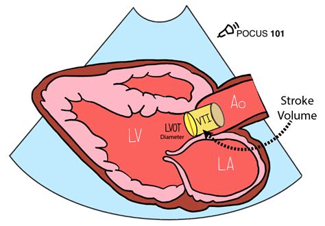Does Measuring Cardiac Output ️ With Pocus Seem Confusing 😕 Lets