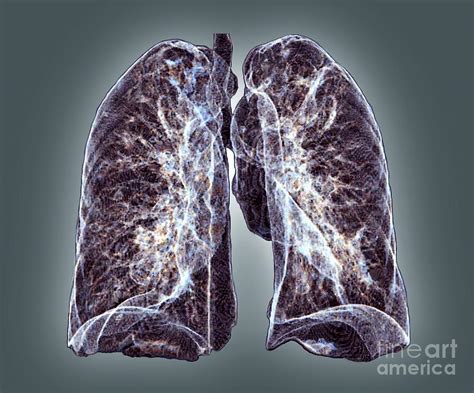 Healthy Lungs 3d Ct Scan Photograph By Zephyr Pixels