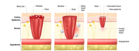 Wound Healing Medical Exam Prep