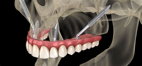 Zygomatic Dental Implants In Delhi NCR The Dental Roots