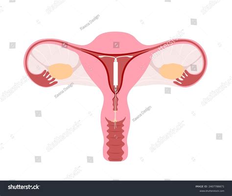 Intrauterine Device Hormone Capsule Inside Uterus Stock Vector Royalty