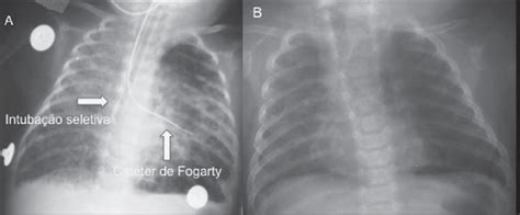 Anteroposterior Chest Radiography A Treatment With Selective