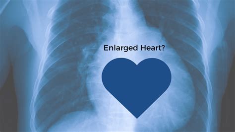 13 Causes Of An Enlarged Heart