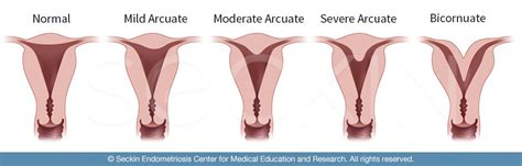 Uterine Anomalies and How They Relate to Endometriosis