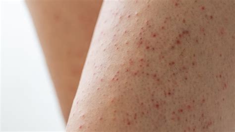 Apa Itu Penyakit Keratosis Pilaris Gejala Cara Mengatasinya