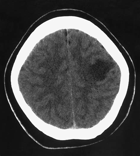 Acute Demyelinating Disorder Appearing As Multiple Cystic Brain Lesions Demyelinating