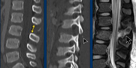 The Radiology Assistant Ao Spine Classification Of Thoracolumbar