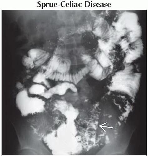 Da Db Irregular Diffuse Small Bowel Fold Thickening Ffu