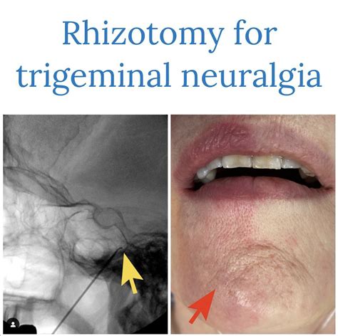 Trigeminal Neuralgia Treatment