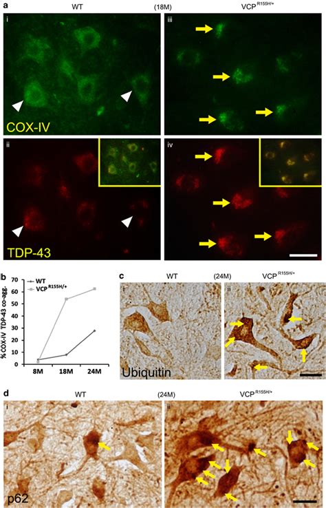 Colocalization Of Mitochondrial Aggregates With TDP 43 And Occurrence