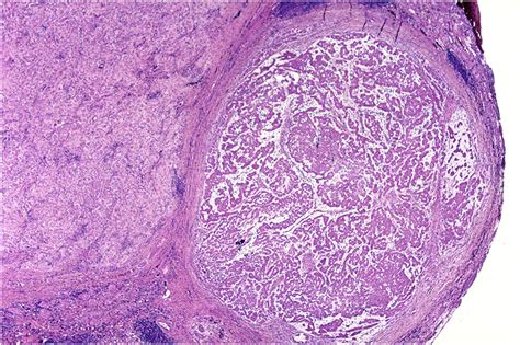 Sex Cord Stromal Tumors Of The Testis Diagnostic Histopathology