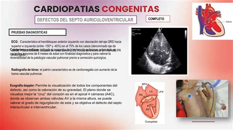 Cardiopatia Congenitas Clasificacion Presentacion Clinicas Y