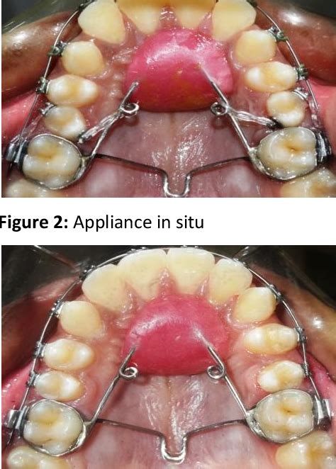 Figure 2 From MODIFIED NANCE PALATAL ARCH FOR DEROTATION OF TOOTH CASE