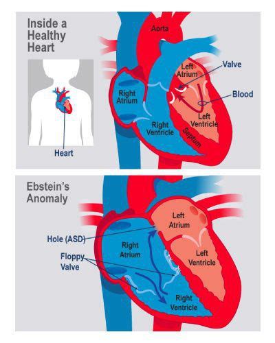 Cause Of Ebstein Anomaly MEDizzy