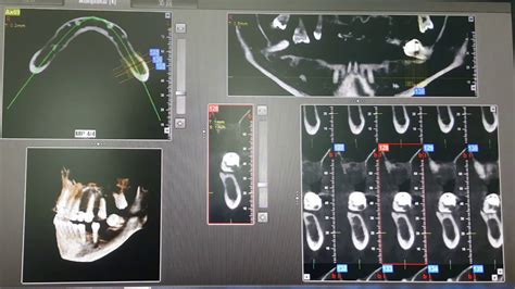 Cbct Mandible Or Cone Beam Ct Xray Explained In Minutes Youtube