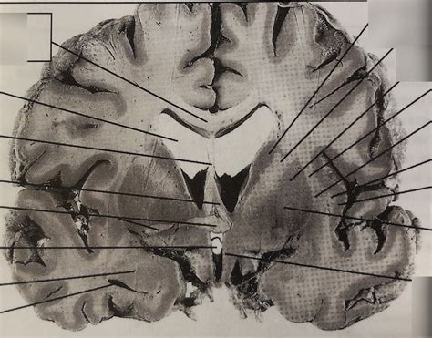 Exam 2 Coronal Cut Diagram Quizlet