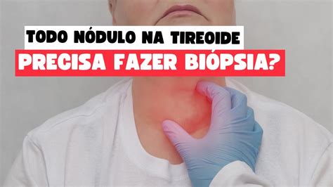 PAAF de Nódulo na Tireoide Quando e Por Que Realizar esse Importante