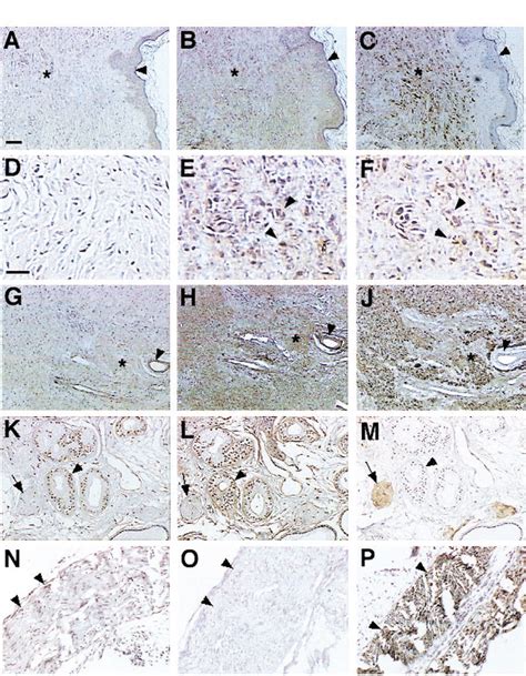 Immunohistochemical Localization Of MK PTN And S 100 In Benign