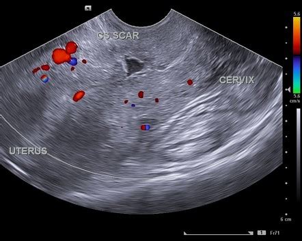 Caesarean Scar Niche Radiology Reference Article Radiopaedia Org