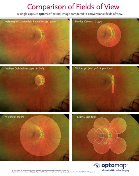 Optimal Retina Imaging Eye Test Exam Eye Care Orangeville