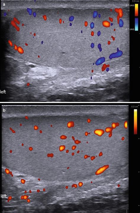 Scrotal Ultrasound Radiology Key