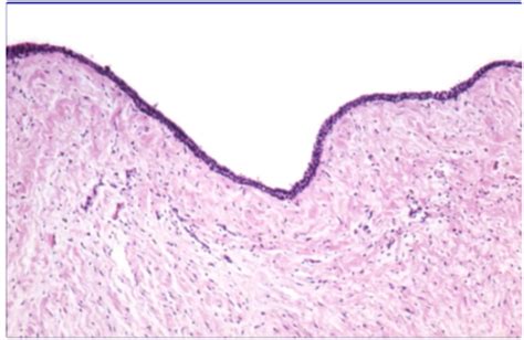 Op Non Odontogenic Cysts Of The Oral Tissues Flashcards Quizlet