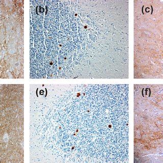 Immunolabelling Of PrP Sc In SCJD And BSE Brain Tissue Samples