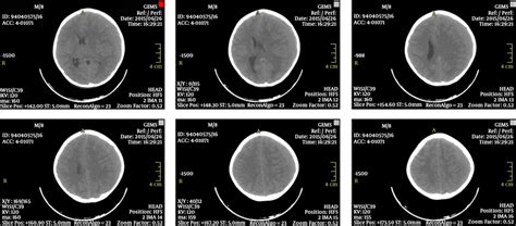 Brain Computed Tomography Scan Showing A Left Side Chronic Subdural