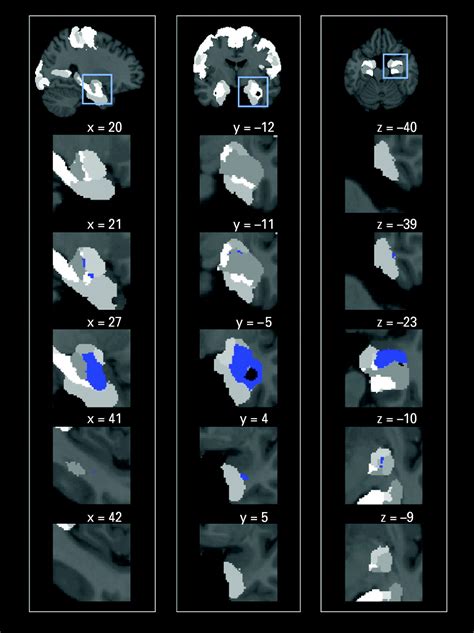 Human amygdala reactivity is diminished by the β noradrenergic