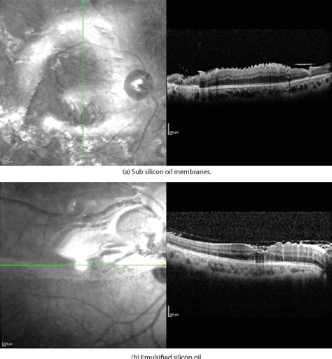 Figure 1 From SD OCT Features Of Macula And Silicon Oil Retinal