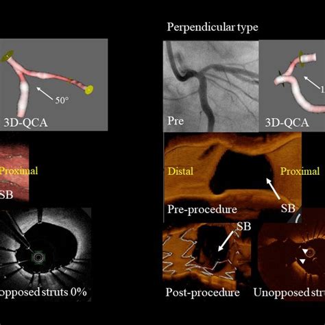 Representative 3D OCT Bifurcation Types Parallel Type Jailed Stent