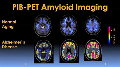 How To Diagnose Alzheimer's Disease - Askexcitement5