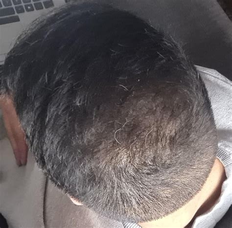 Dr Emrah Cinik Grafts Th November Hair Transplant Reviews