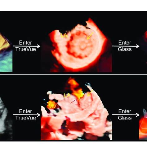 Three Dimensional Transesophageal Echocardiography Plus Color Doppler