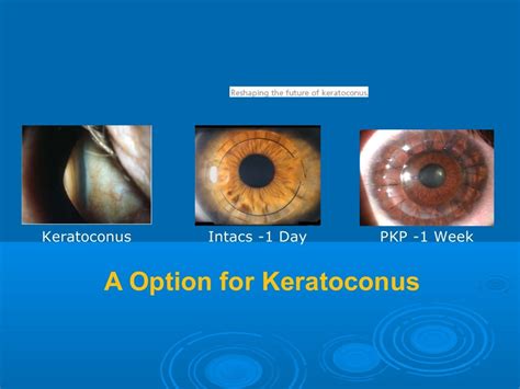 Intacs Corneal Inserts For Treatment Of Keratoconus And Ectasia