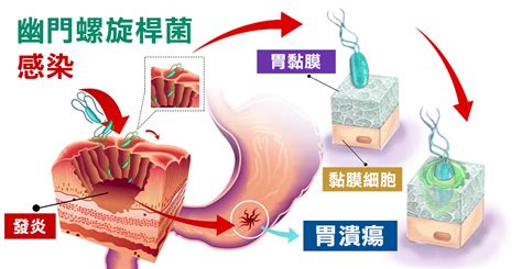 幽門螺旋桿菌檢查 多麗診所