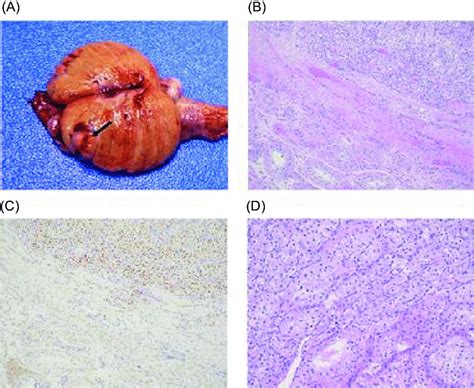 Gross And Microscopic Pathology Of Right Radical Orchiectomy Specimen