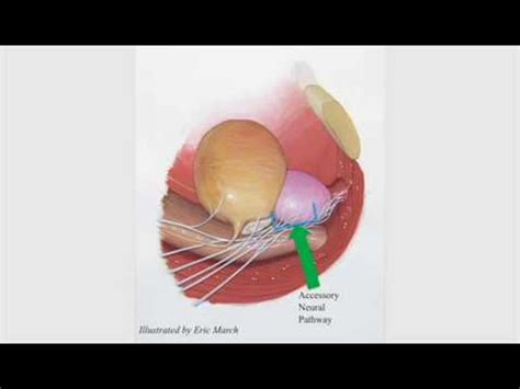 An Updated Approach To Incremental Nerve Sparing For Robotassisted