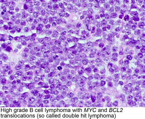 Pathology Outlines High Grade B Cell Lymphoma With MYC And BCL2 Or