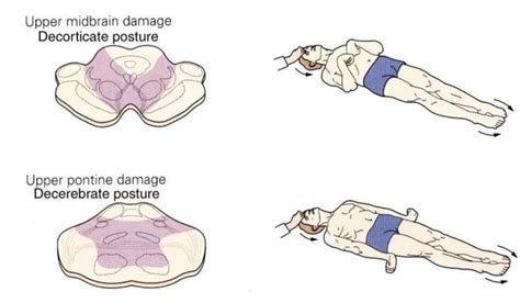 Decorticate Posture : Introduction, Cause, Diagnosis, Treatment