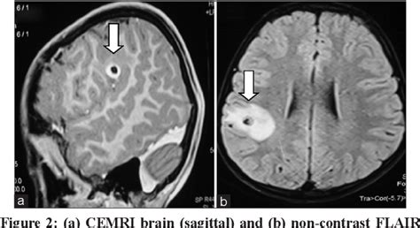 Table 1 From Radiological Screening For Neurocysticercosis In